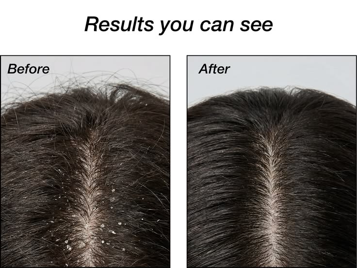 ZP11 + Argan Oil Anti-Dandruff Shampoo